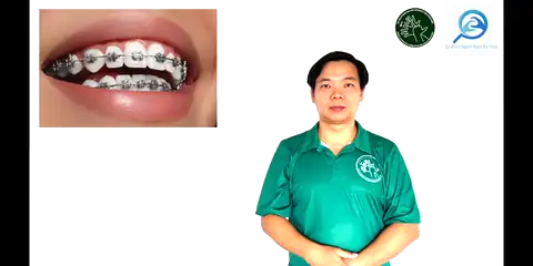 niềng răng - Ngôn Ngữ ký Hiệu - Vùng miền Thành Phố Hồ Chí Minh - Phân loại Sức khỏe - Bộ phận cơ thể, Danh Từ, Dự Án 250 Ký Hiệu Y Khoa