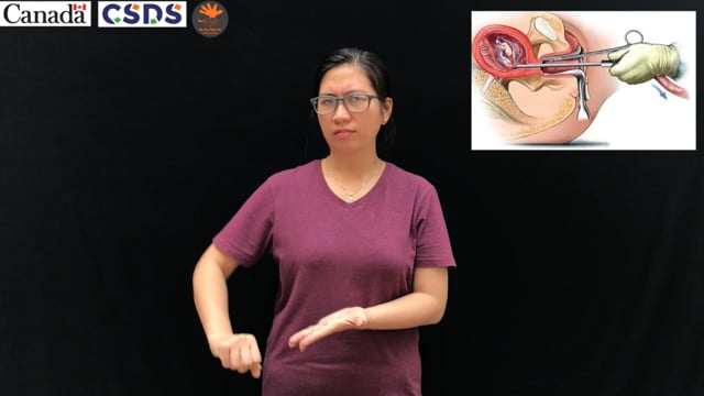 Nạo thai