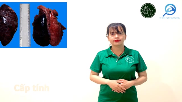 cấp tính (1)