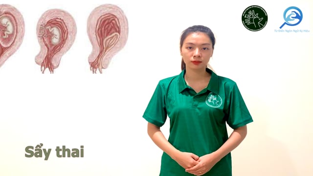 sẩy thai