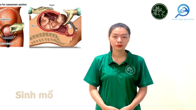 sinh mổ