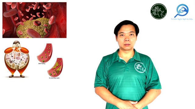 tăng mỡ máu