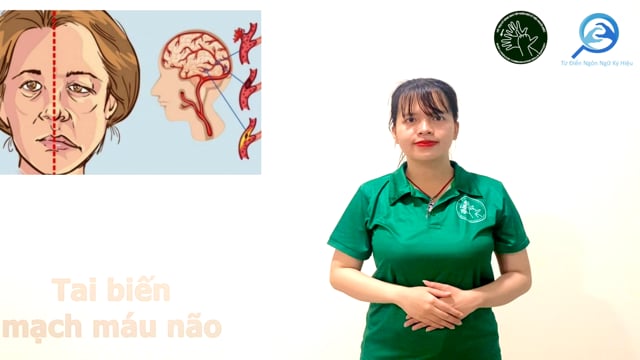 tai biến mạch máu não