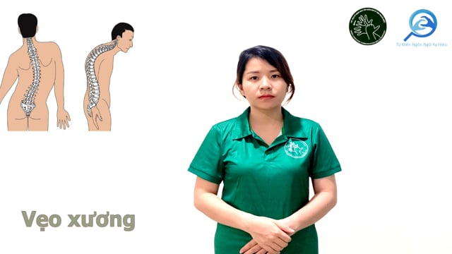 vẹo xương